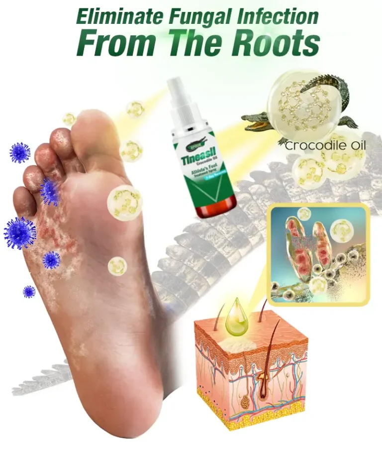 GFOUK™ Tineasil Athlete's Foot Crocodile Oil Treatment Spray - Image 4