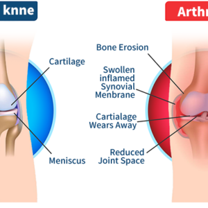 FLYCARE™ Bee Venom Advanced Joint and Bone Therapy Cream