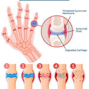 FLYCARE™ Bee Venom Advanced Joint and Bone Therapy Cream