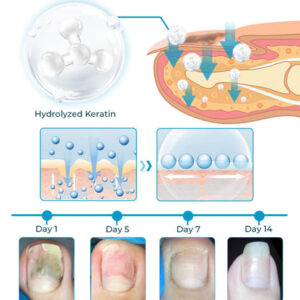 FLYCARE™ Bee Venom Nail Fungus Treatment Elixir