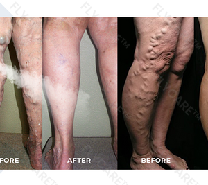 FLYCARE™ Varicose Veins Spray