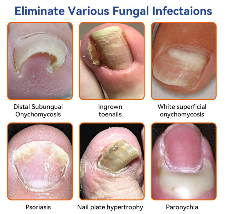 Lotmay® Bee Venom Nail Fungus Treatment Solution