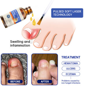 Lotmay® Bee Venom Nail Fungus Treatment Solution