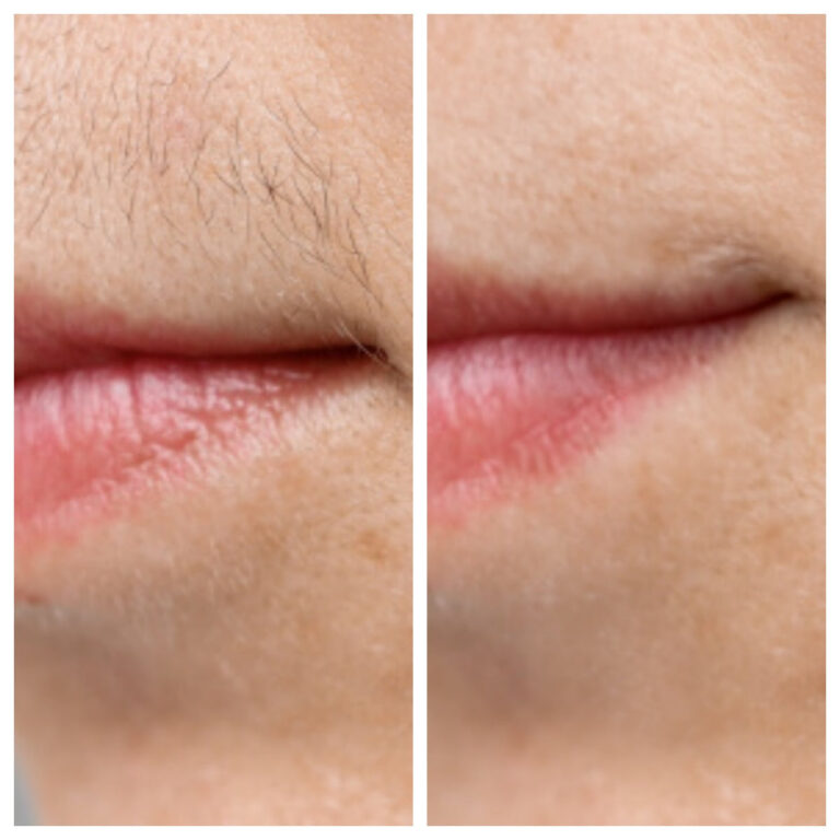 PCOS Facial Hair Natural Treatment At Home