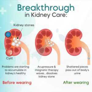 AEXZR™ Kidney Care Point Clip