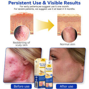 LOVILDS™ PsoriaHeal Bee Venom Psoriasis Treatment Spray