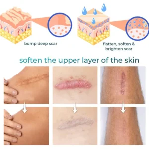 LOVILDS™ Advanced Scar Removal Gel