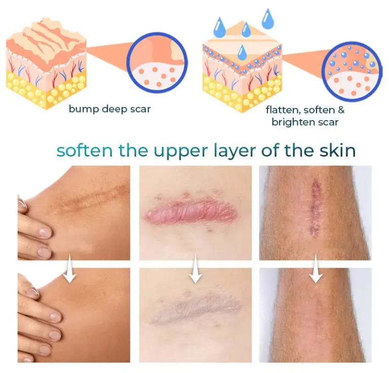 LOVILDS™ Advanced Scar Removal Gel