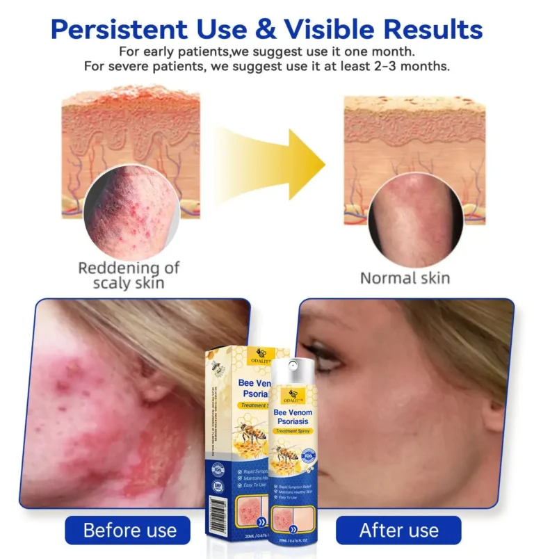 ODALIT™PsoriaHeal psoriasis Spray