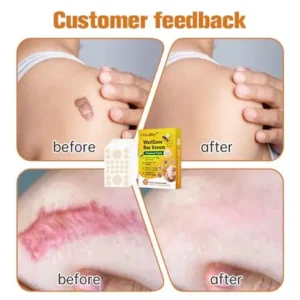 Oveallgo™ WartGone Bee Venom Treatment Patch