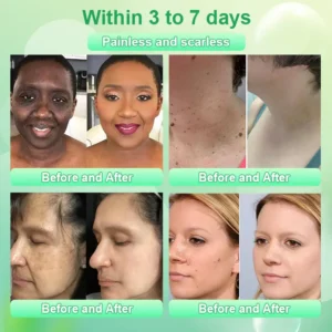 Purifying Exfoliating Gel for Acanthosis Nigricans