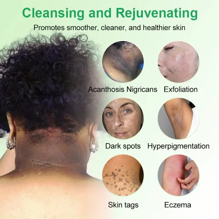 Purifying Exfoliating Gel for Acanthosis Nigricans