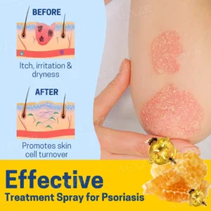 BeeVenz™ Bee Venom Psoriasis Treatment Spray