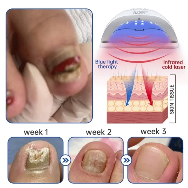 Furzero™ PureNail Fungus Laser Device