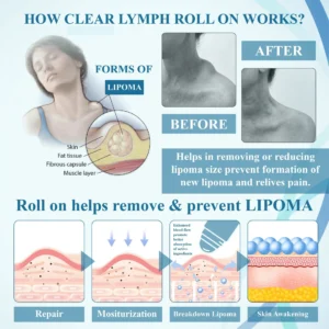 Lovilds™ LumpsClear Lymph Say Goodbye to Lipomas and Swelling