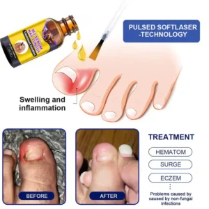 AEXZR™ Bee Venom Nail Fungus Treatment Solution