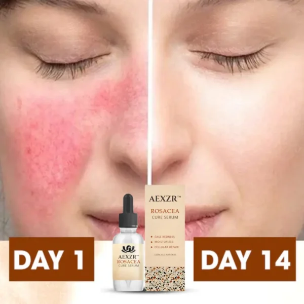 AEXZR™ Rosacea Cure Serum