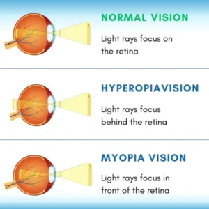 VizoClear™ Daily Liquid Lens